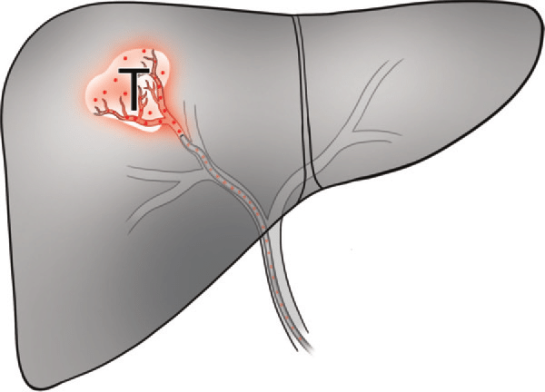 Radioembolization Y-91 in Alamogordo